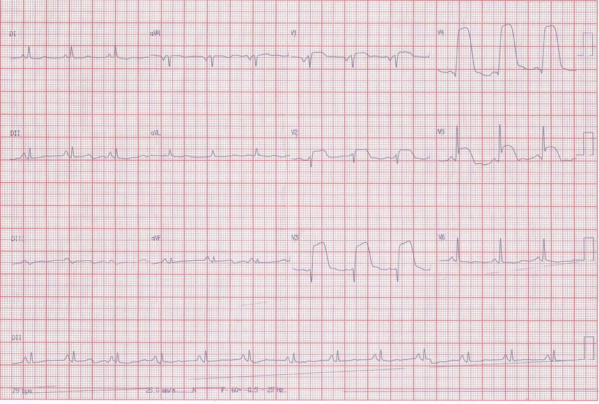 Paciente masculino de 73 años con angor prolongado por perforación de arteria DA