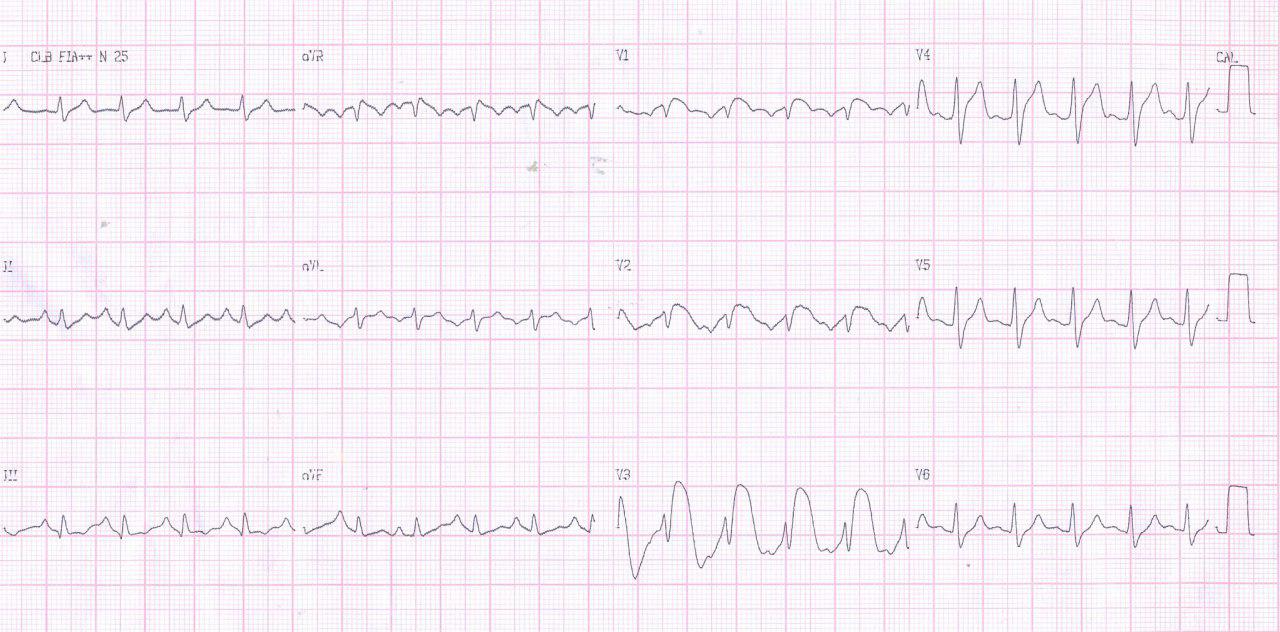 Hombre de 40 años, asmático crónico que cursa con infección pulmonar, severa disnea y cianosis con acidosis e hiperK que determinan una fenocopia de Brugada