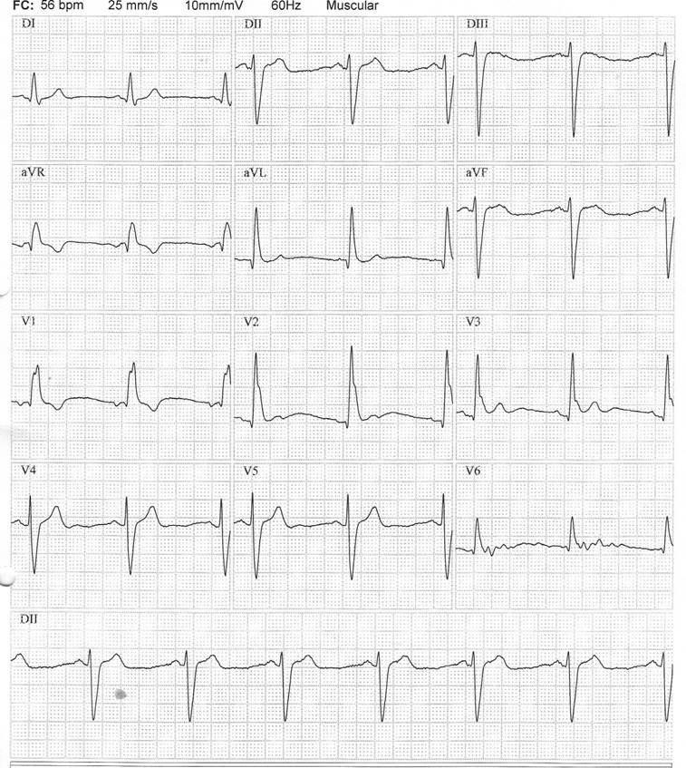 Paciente masculino de 72 años que presenta síncopes al esfuerzo por presentar enfermedad de Lev y desarrollo de bloqueo trifascicular en Fase 3