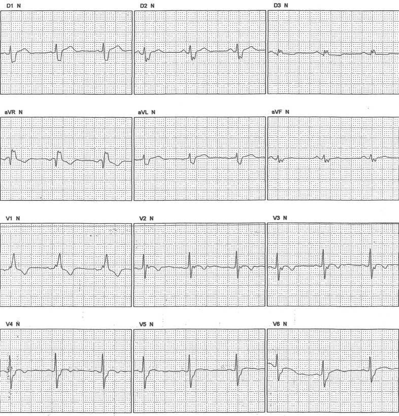 Mujer con historia de palpitaciones y síncope que presenta BCRD y onda epsilon por miocardiopatía arritmogénica de VD
