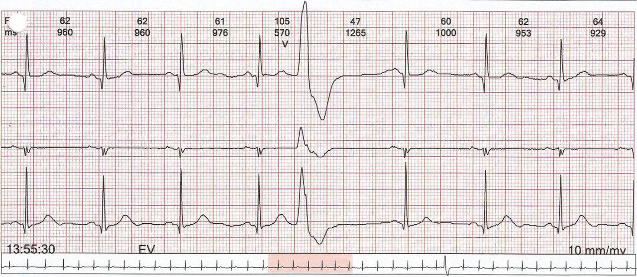 Mujer de 78 años con antecedentes de ACV que presenta palpitaciones atribuibles a la presencia de Síndrome de Bayés