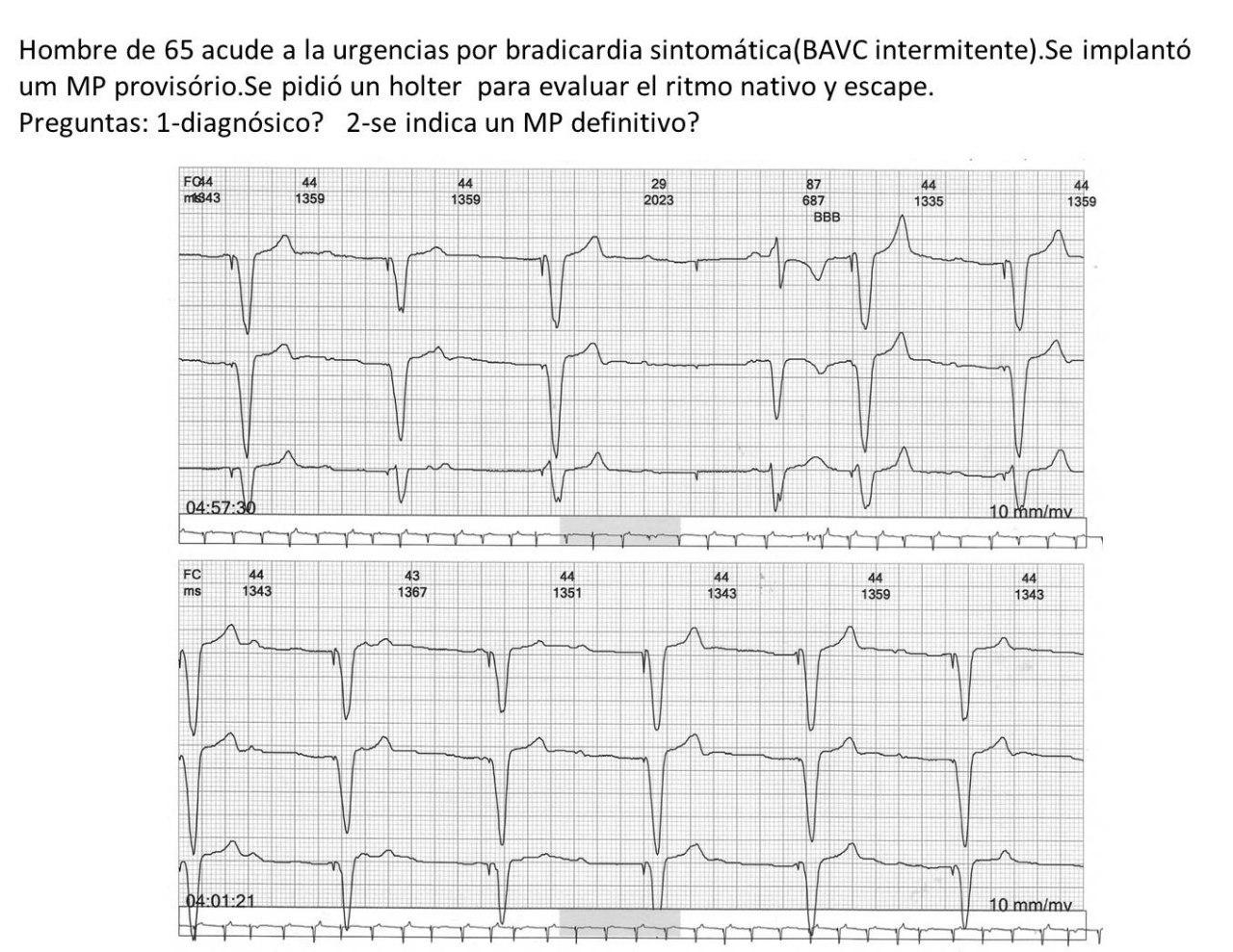Paciente masculino de 65 años sintomático por BAVC intermitente por enfermedad grave del Haz de His a quién se implante MP transitorio con fallas de captura