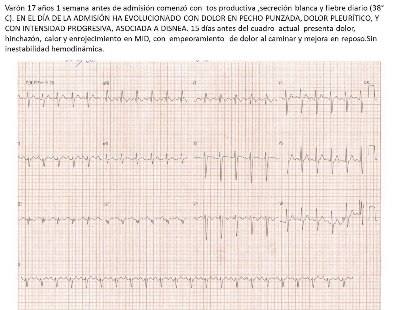 Paciente masculino de 17 años que presenta cuadro de dolor de tipo pleurítico, disnea y fiebre con presencia de patrón S1Q3T3 en el ECG por TEP originado en deficiencia de proteína S