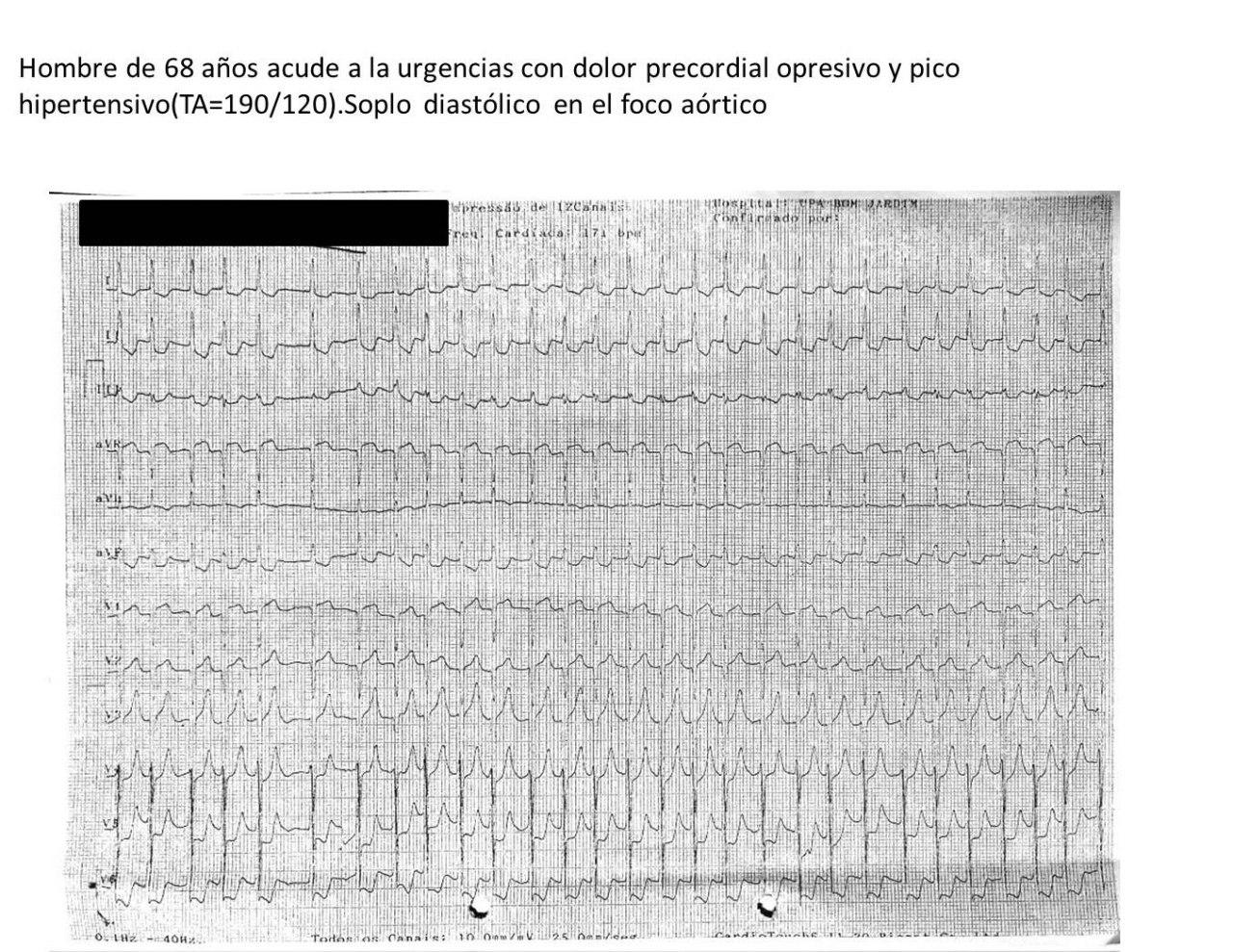 Hombre de 68 años con  dolor precordial, hipertensión y soplo diastólico aórtico de causa no determinada con arterias coronarias normales y en quién se descarta disección
