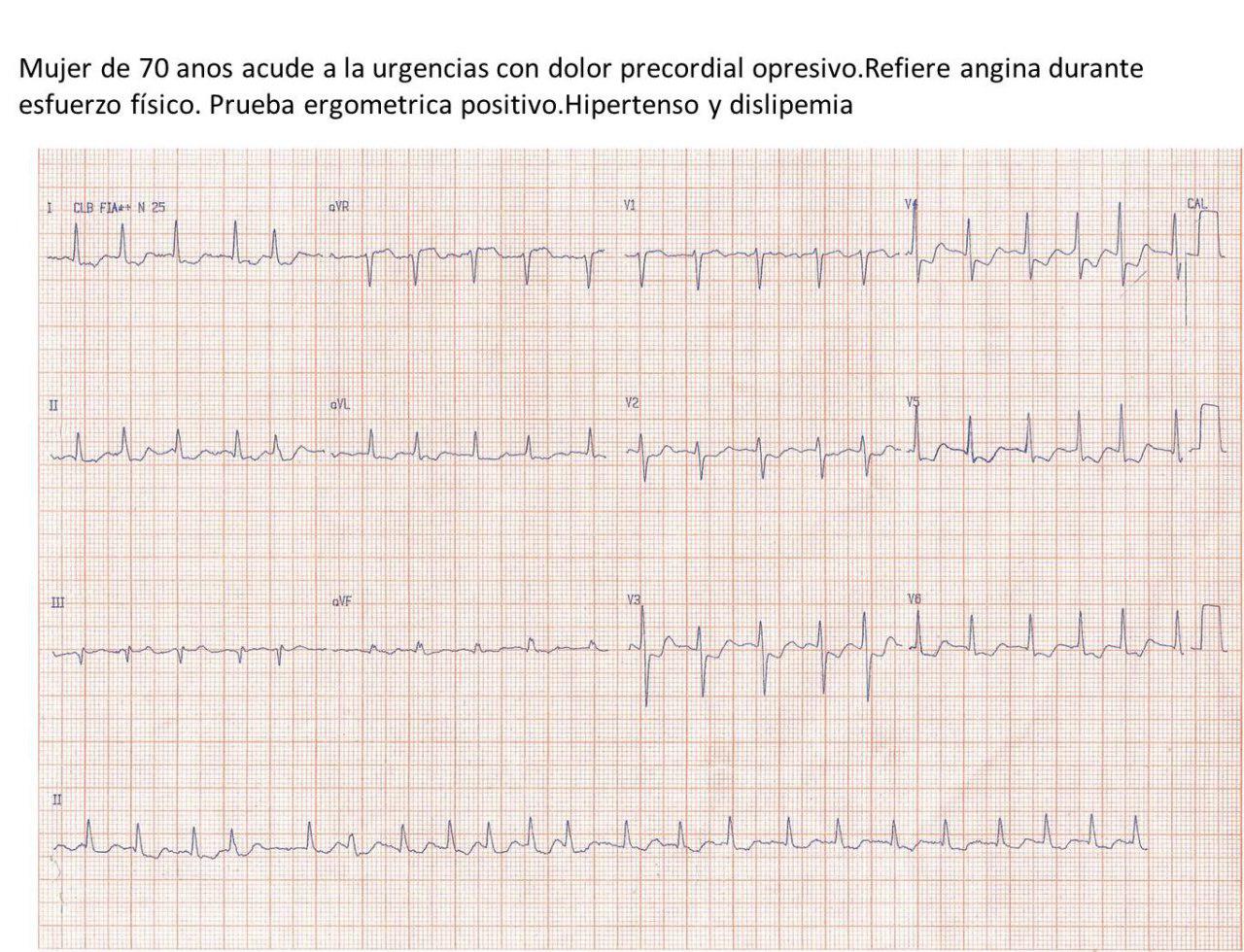Mujer de 70 años con factores de riesgo que presenta angor de esfuerzo y de reposo por severa lesión proximal de tres vasos