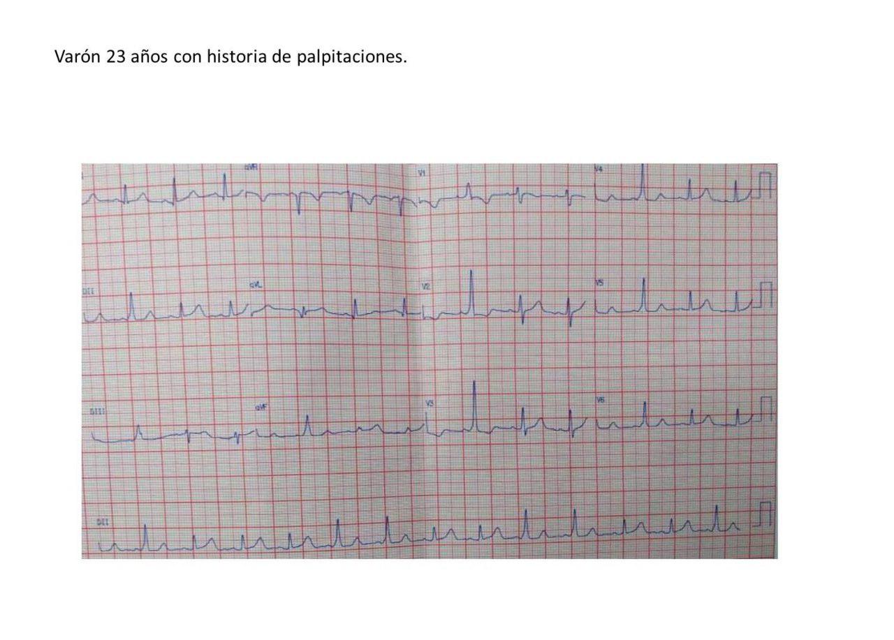 Varón de 23 años sin cardiopatía estructural o disfunción ventricular con preexcitación intermitente