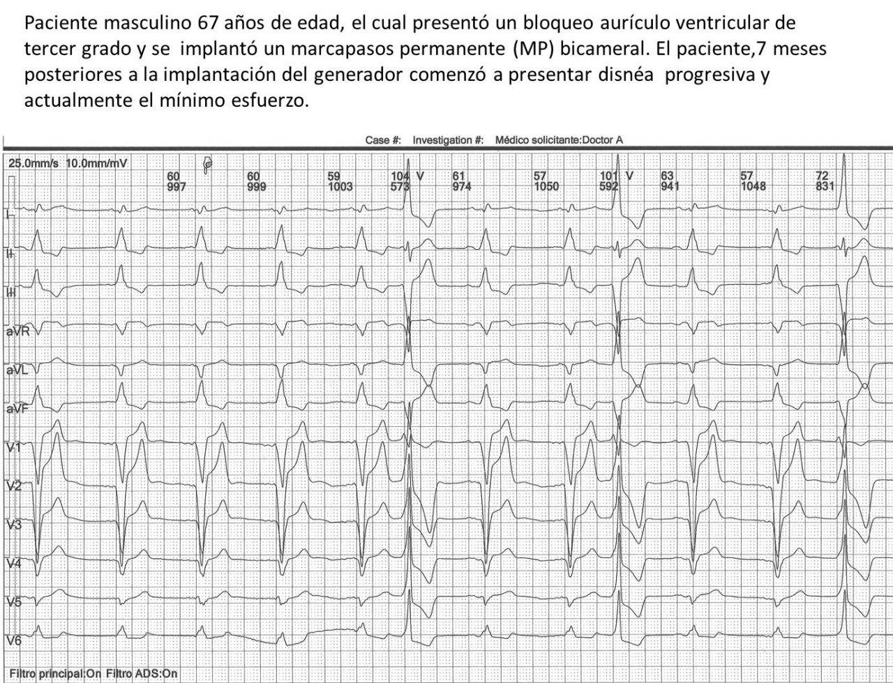 Paciente masculino de 67 años con implante de marcapasos bicameral por BAVC que desarrolla disnea progresiva por síndrome de marcapasos