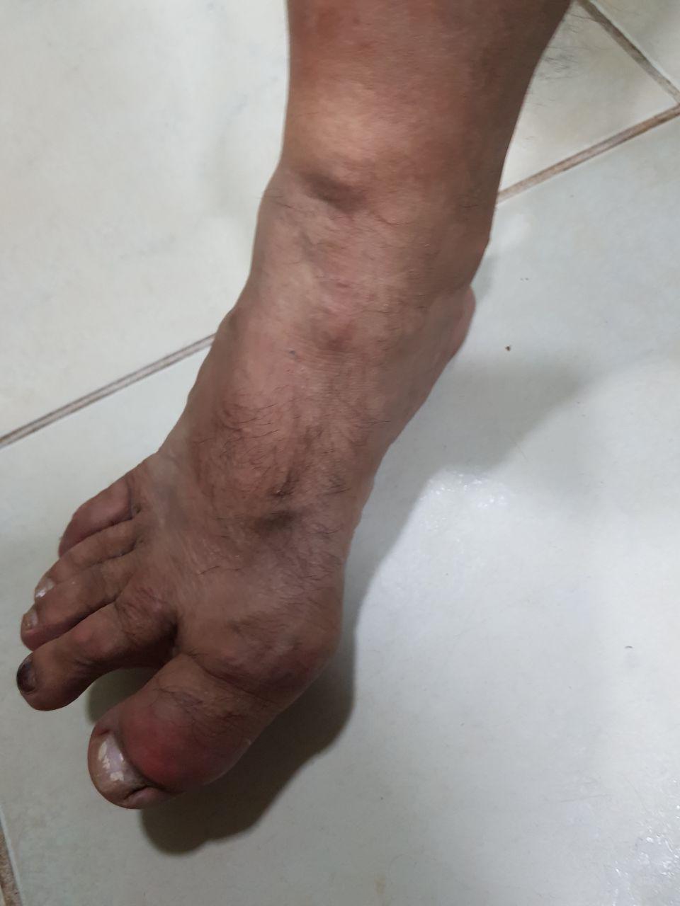 Paciente masculino de 51 años con severa artritis gotosa