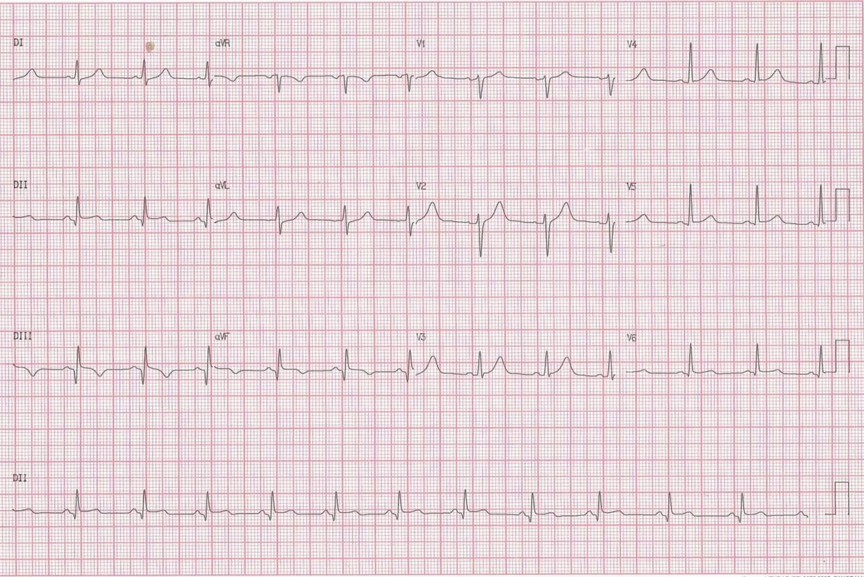 Sendos pacientes masculinos de 25 y 41 años con SCA post consumo del suplemento OxyElite Pro (OEP – 1.3-dimethylamylamine (DMAA)). CCG del primero y ECG post revascularización del 2do