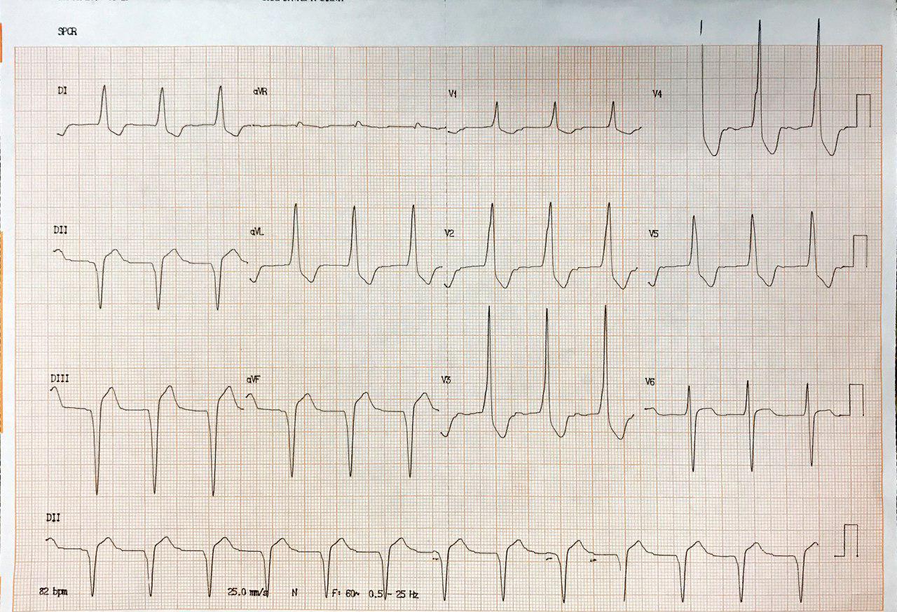 Hombre de 66 años con antecedente de cirugía de reemplazo valvular mitral en tratamiento con digoxina que presenta ritmo idioventricular e intoxicación digitálica