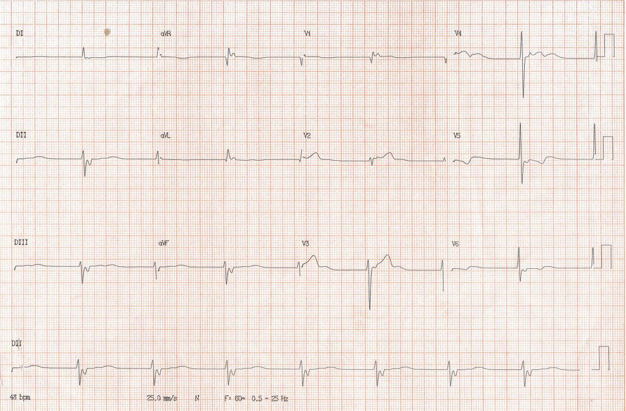 Paciente de 72 años con disnea y mareos que presenta ritmo de la unión con conducción retrógrada por probable bloqueo sino auricular de tercer grado como manifestación de enfermedad del nódulo sinusal