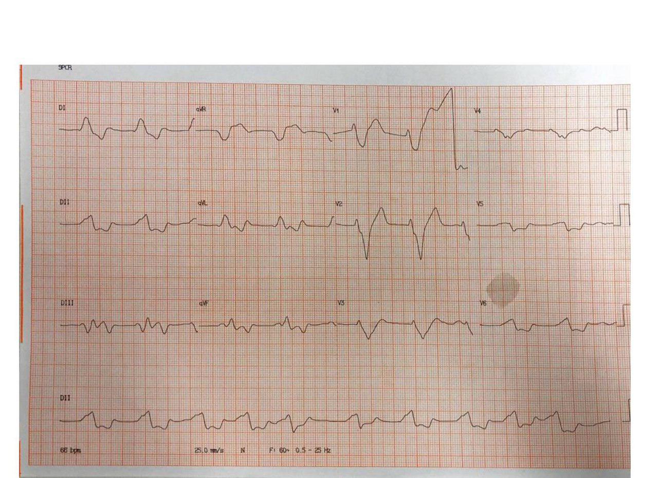 Mujer de 82 años, HTA y DBT con severa hiperpotasemia secundaria a medicación que es tratada con gluconato de Ca