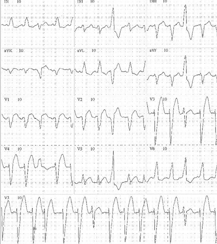 Mujer de 84 años hipertensa y diabética que cursa IAM asociado a BCRI por compromiso de DA proximal