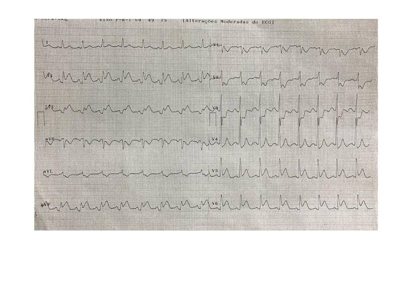 Hombre de 76 años con factores de riesgo que cursa SCA con compromiso de cara inferior y auricular por oclusión de Cx