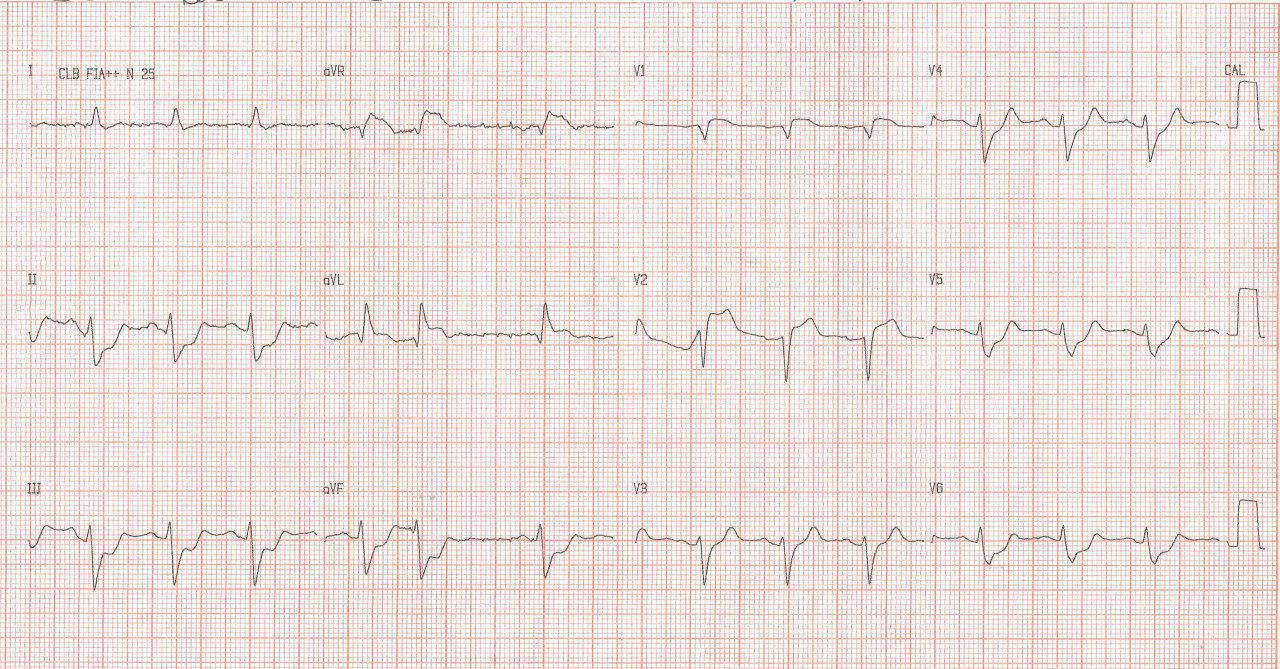 Paciente masculino de 55 años con angor de comienzo súbito y rápido deterioro hemodinámico por oclusión total de TCI