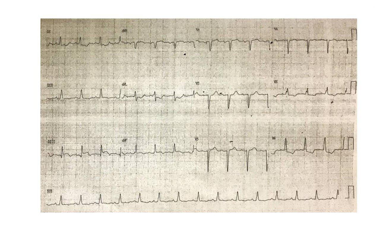 Paciente de 72 años con SCA  a quién se coloca stent en CD presentando a posteriori reiterados episodios de TV polimorfa por oclusión de los mismos y posterior oclusión de DA con trombo