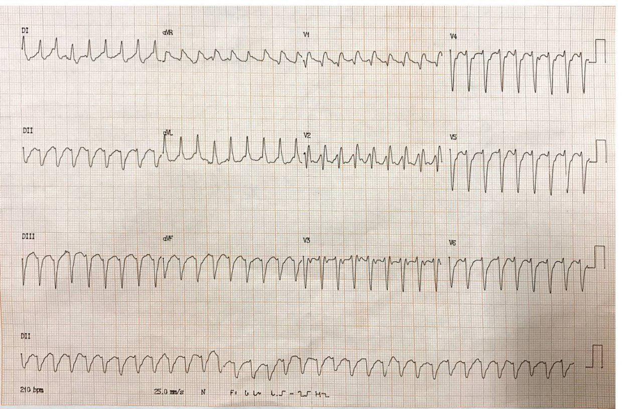 Hombre de 47 años hipertenso y diabético, con antecedente de ACV isquémico y CCG normal, que presenta taquicardia fascicular posterior