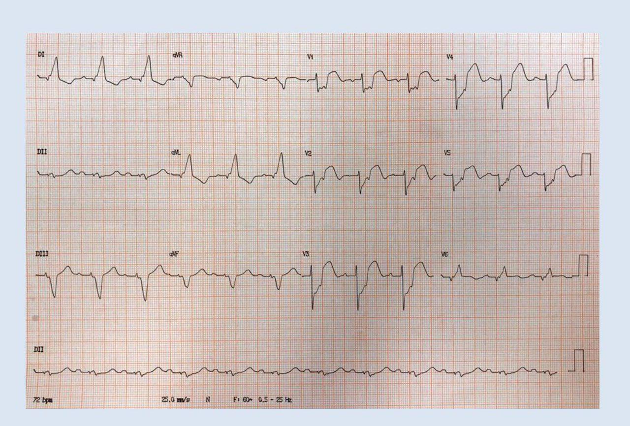 Hombre de 58 años con factores de riesgo y antecedentes de infarto previo e implante de CDI que presenta EAP en contexto de SCA con BCRI por oclusión total de DA