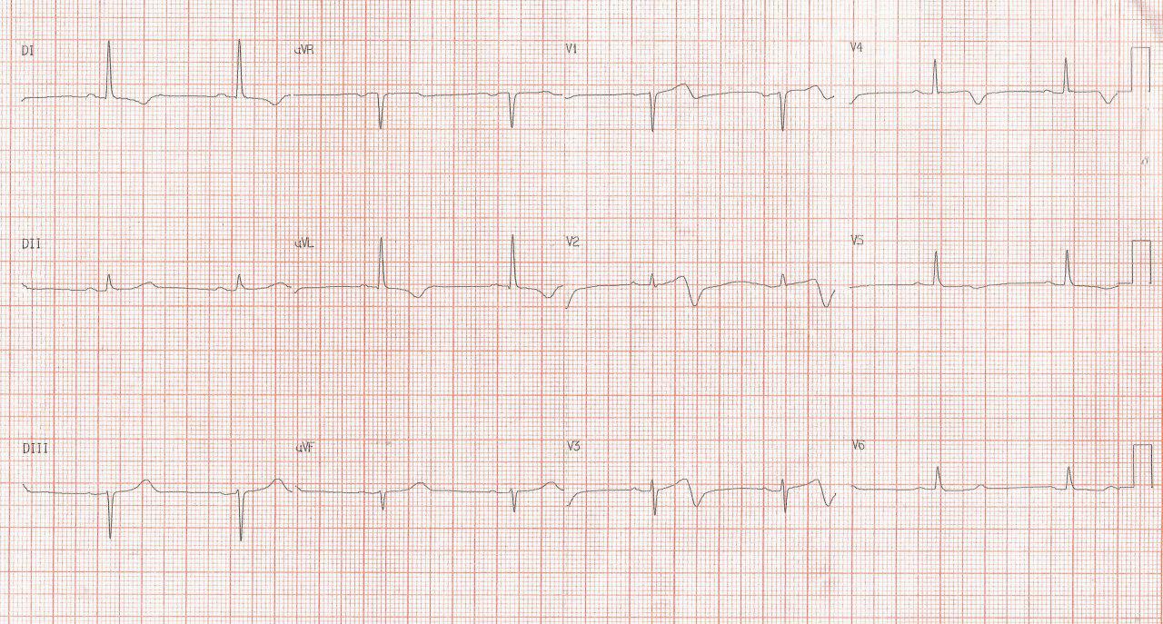 Paciente masculino de 77 años con múltiples factores de riesgo y antecedente de implante de stent hace un mes que presenta angor inestable por suboclusión de la DA