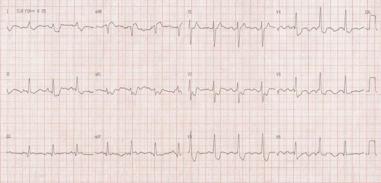 Paciente masculino en tratamiento con digoxina por ICC que presenta anorexia, astenia y adinamia por intoxicación digitálica