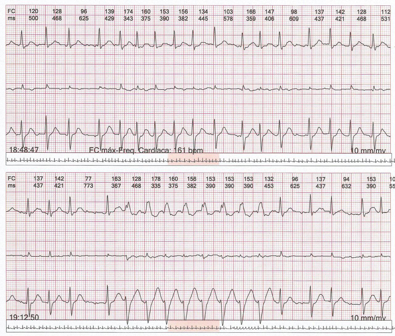 Paciente masculino de 69 años con palpitaciones debidas a FA rápida que presenta fenómeno de Ashman