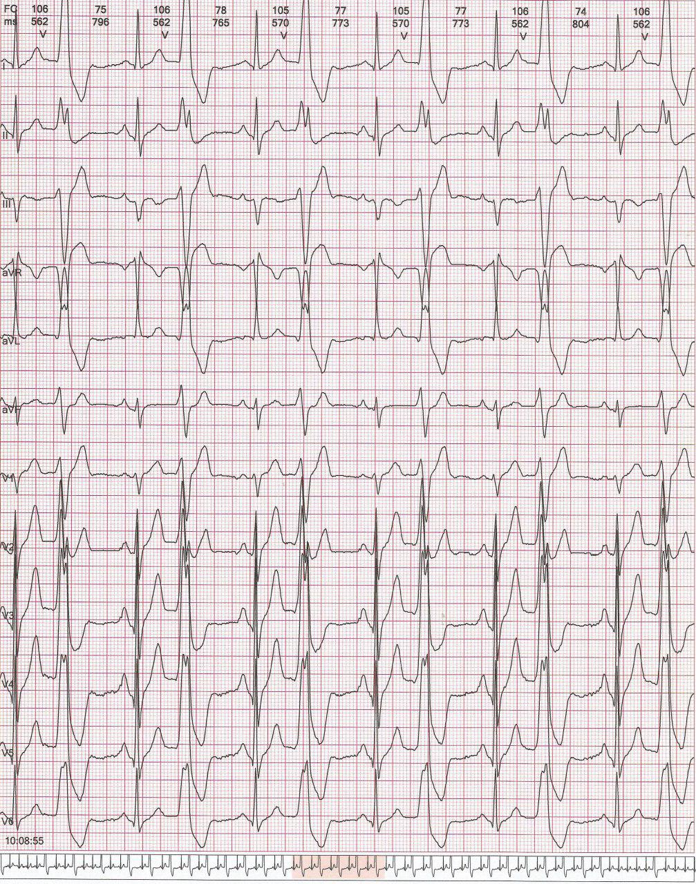 Paciente masculino de 35 años asintomático en quién se detecta extrasistolia ventricular frecuente del tracto de salida del VD