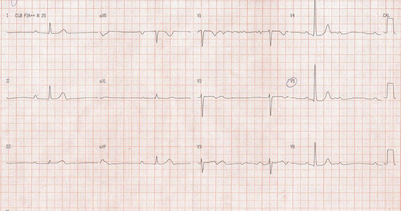 Paciente masculino de 47 años con mareos por BAVC intra His