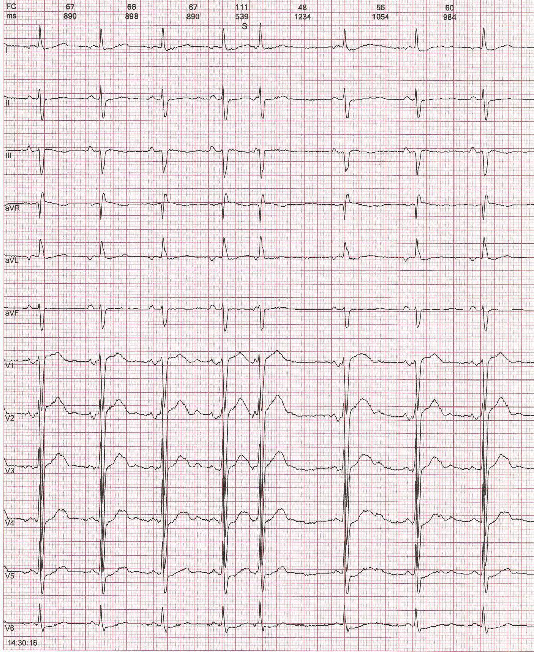 Mujer de 80 años que presenta infección respiratoria y FA (no hay registro) y es medicada con azitromicina y amiodarona presentando RIVA como efecto proarrítimico asociado a hipokalemia de 3,2 meq/dl