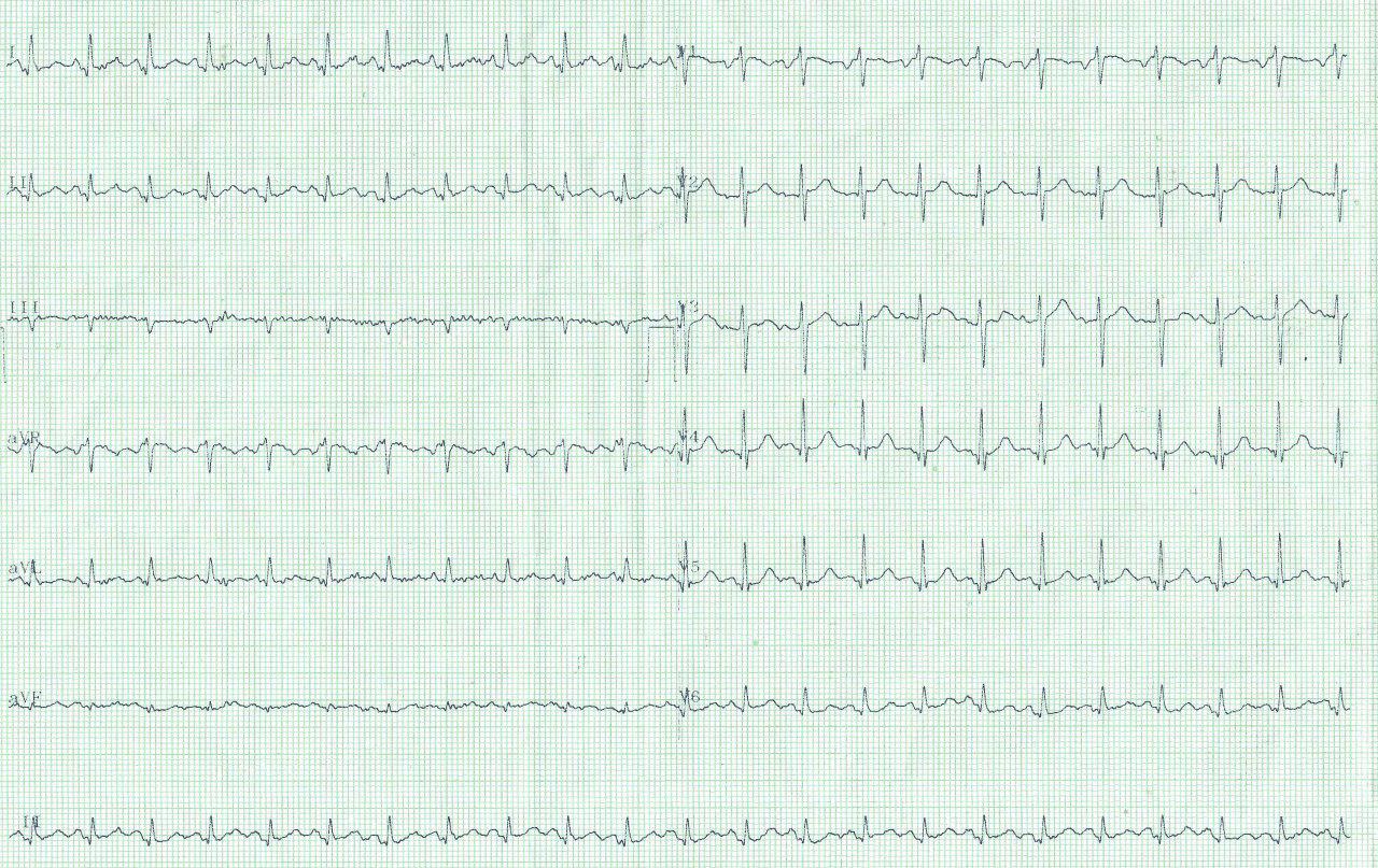 Paciente femenina de 62 años afectada de artritis reumatoidea que presenta típico dolor precordial inspiratorio debido a pericarditis autoinmune con manifiesto signo de Spodick en el ECG