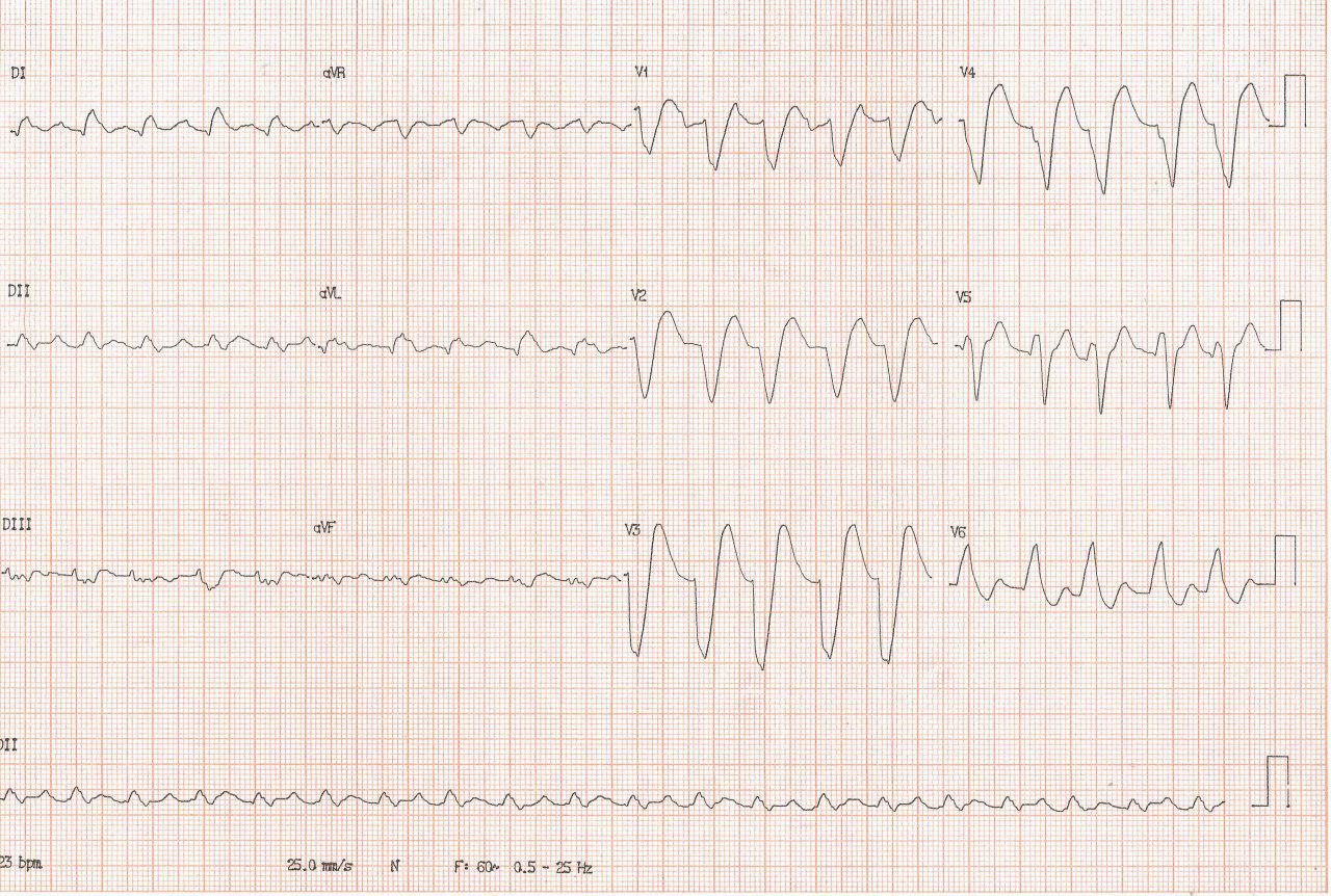 Paciente portador de miocardiopatía dilatada con Fey = 18% que se agrava después de episodio gripal por desarrollo de FA aguda