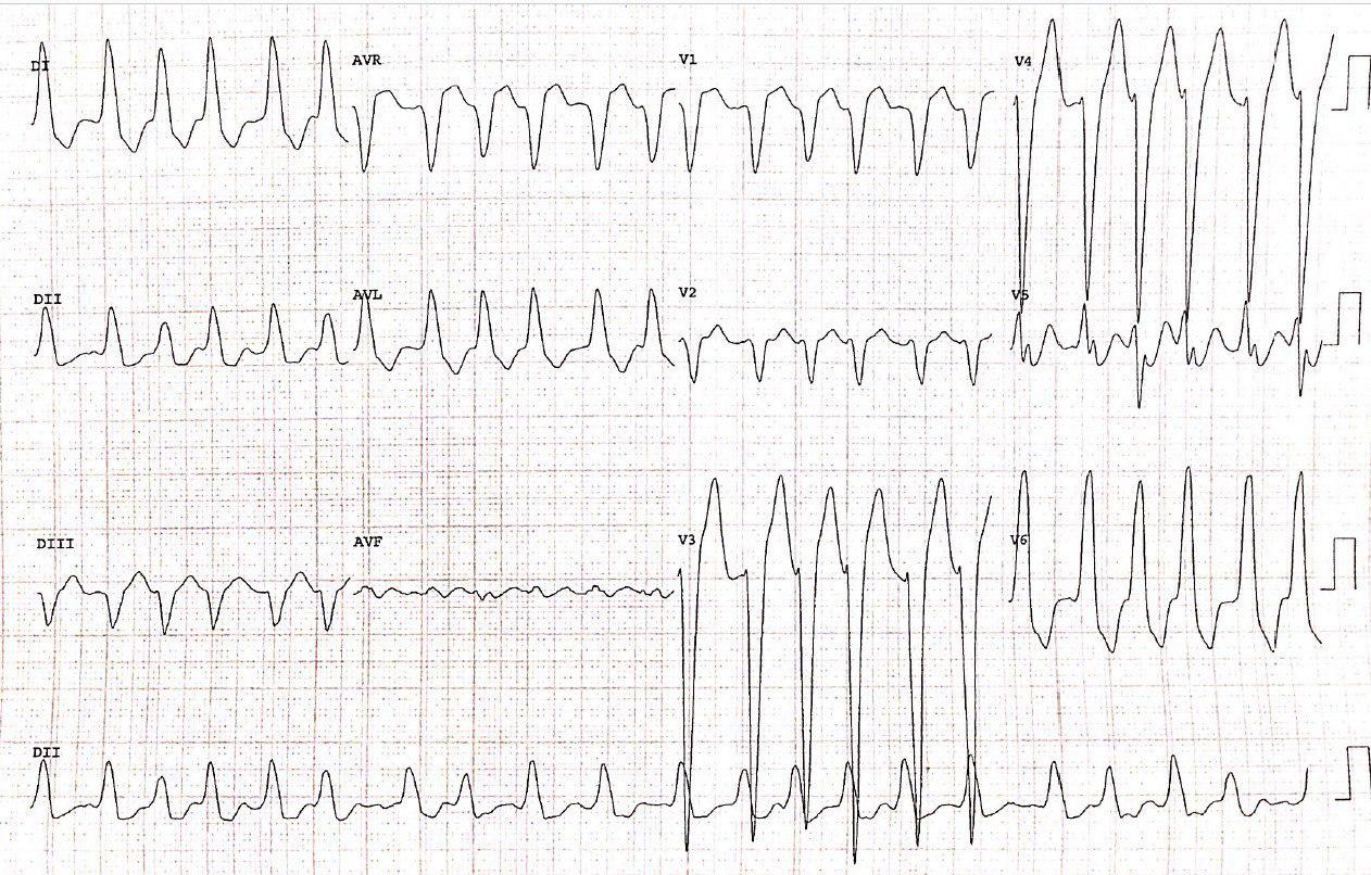 Mujer de 88 años que presenta EAP por presentar FA de alta frecuencia, con elevación de troponinas y sin enfermedad coronaria