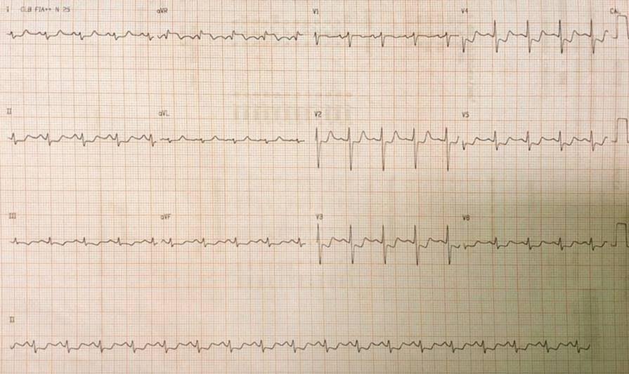 Mujer de 48 años jaquecosa crónica que utiliza ergotamina, que presentó angor prolongado por espasmo de TCI