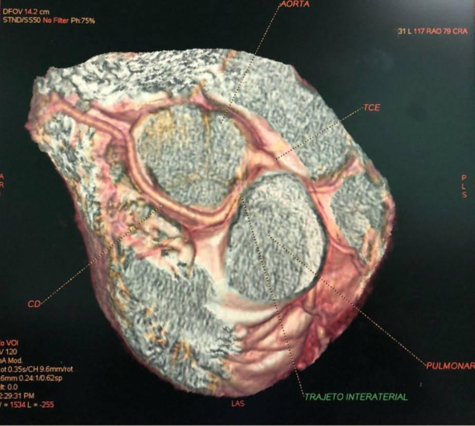 AngioTAC coronaria de joven de 18 años que presenta origen de la arteria coronaria derecha desde el seno coronario izquierdo con curso inter-arterial