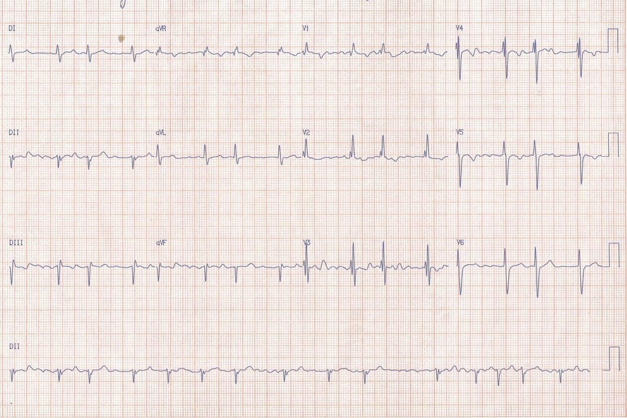 Hombre de 51 años con disnea y palpitaciones por presentar FA, HVD debidas a CIA OS
