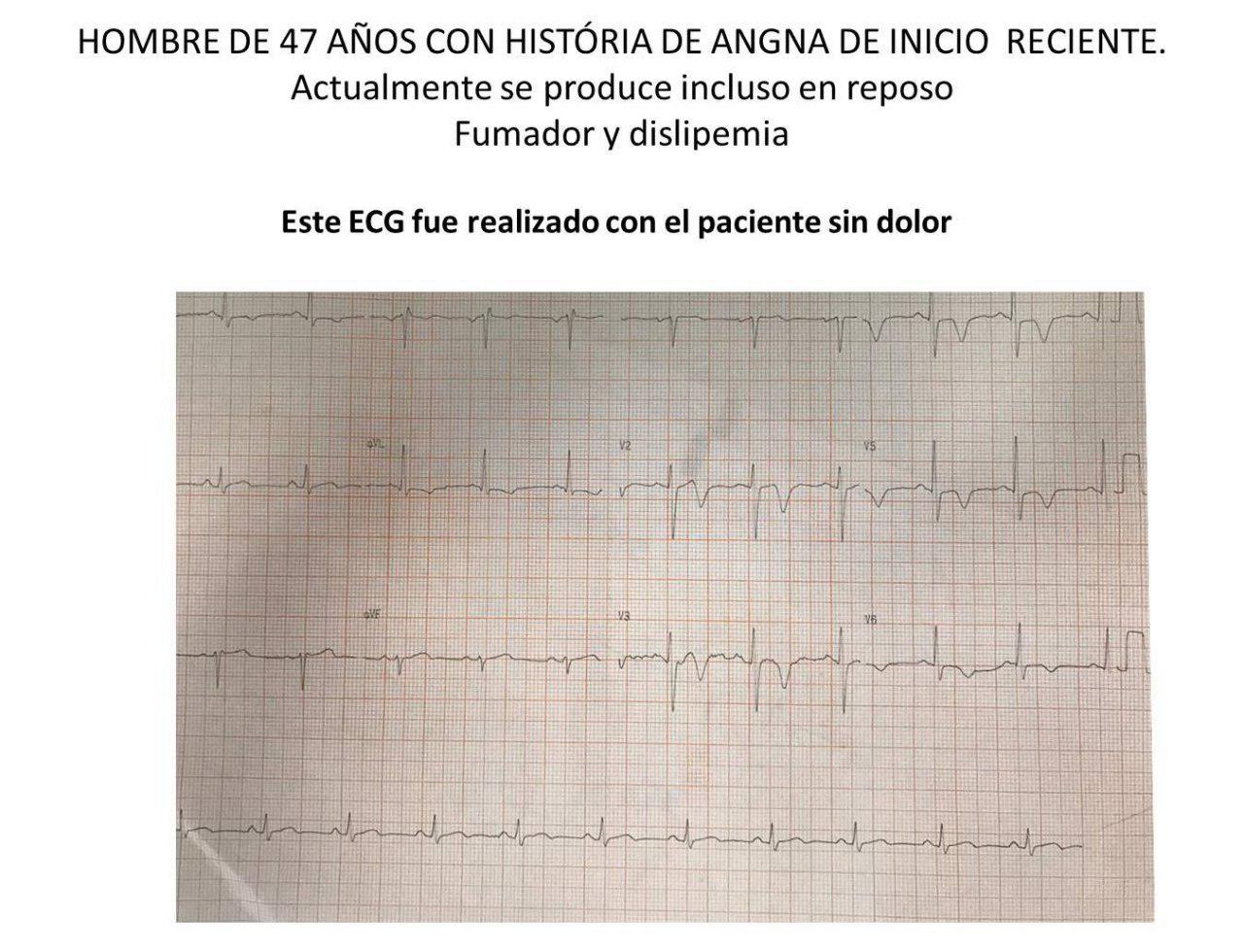 Hombre de 47 años con angina de reciente comienzo y episodios de reposo que presenta suboclusión de DA y pseudonormalización del ST T intradolor