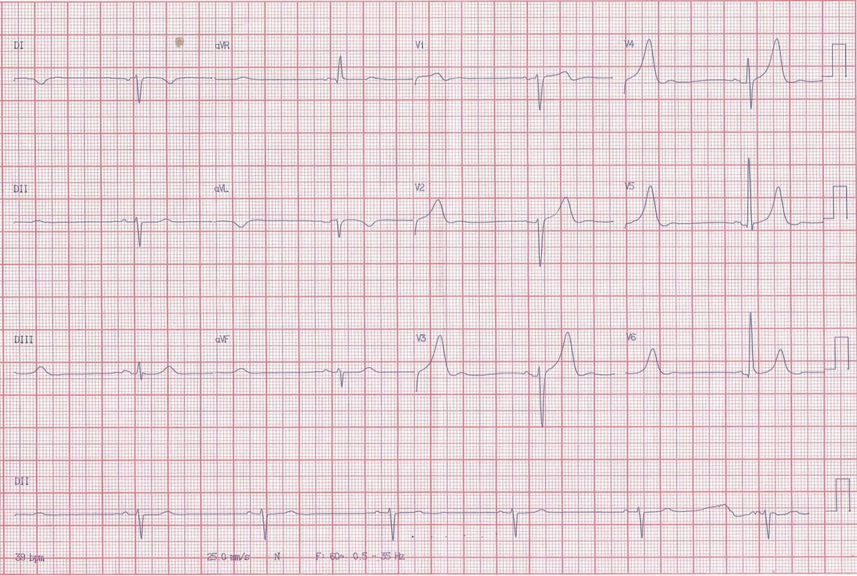 Paciente masculino de 80 años con angor y palpitaciones por alternancia de taquicardia y bradicardia con compromiso de CD y arteria del nódulo sinoauricular (ANSA)