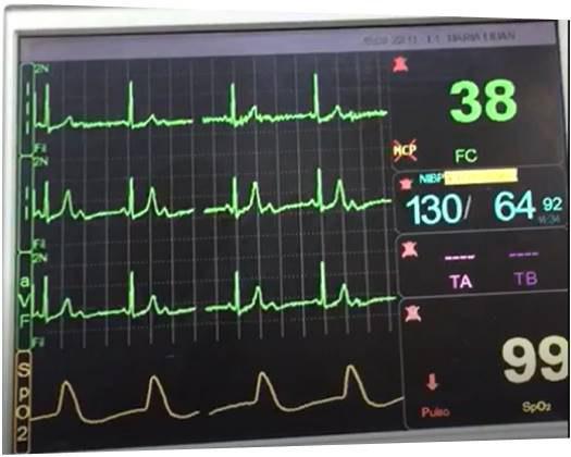 Mujer de 85 años con malestar general que presenta BAV 2:1 infrahisiano