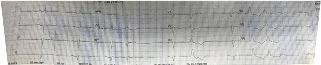 Paciente masculino de 52 años con palpitaciones y presíncope que presenta displasia arritmogénica de VD