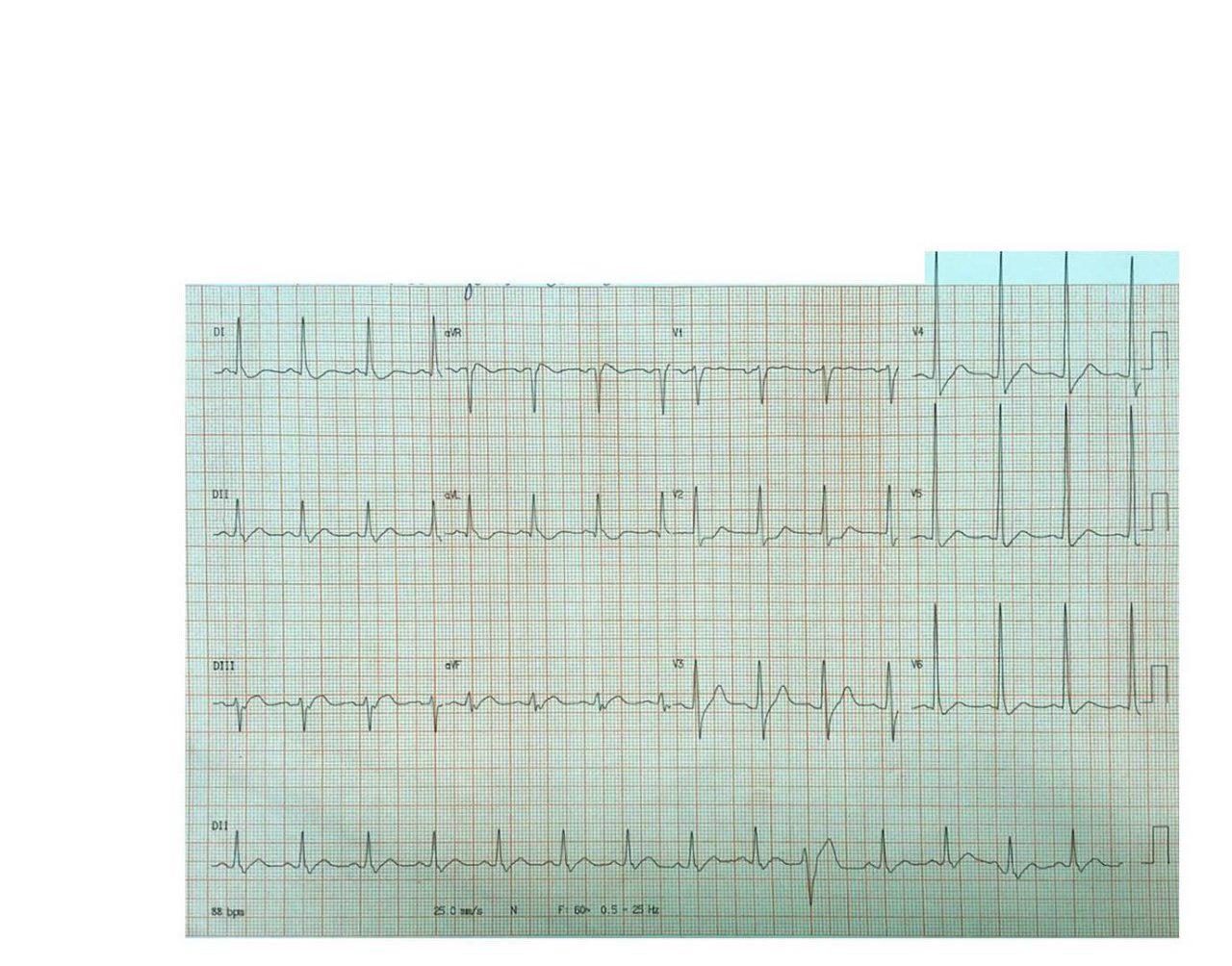 Paciente hipertenso con dolor intenso en región dorsal que presenta IAM lateral (ex dorsal) por oclusión total de Cx, con aortograma normal que descarta la disección sospechada