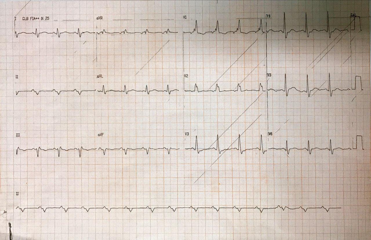 Paciente masculino de 61 años con angor prolongado por compromiso de la Cx interpretado erróneamente como SCASEST