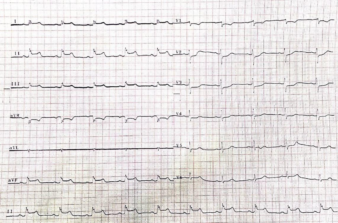 Mujer de 55 años medicada con AINEs que presenta angor y episodio sincopal por vasoespasmo de arteria Cx