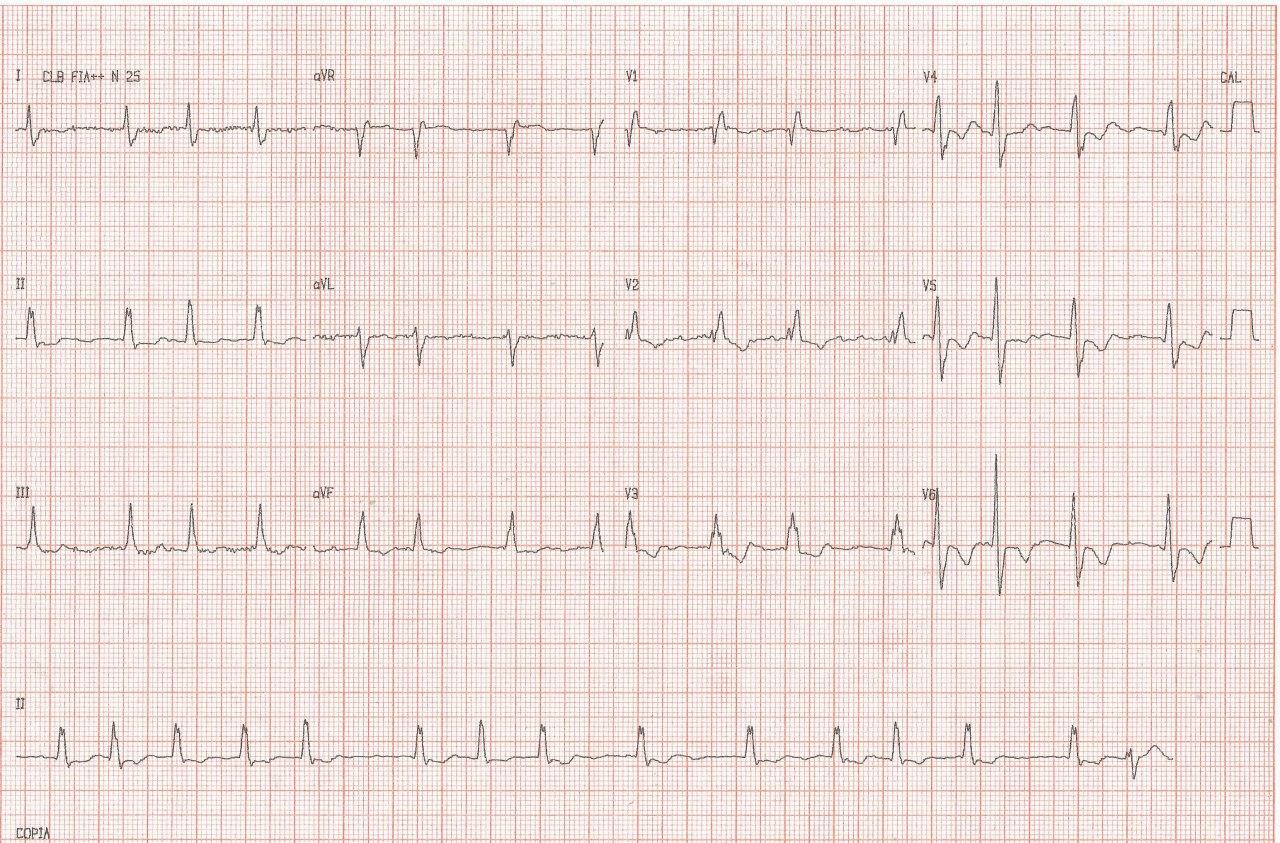 Mujer de 83 años con disnea y cianosis, portadora de CIA tipo seno venoso con conexión anómala parcial de venas pulmonares, shunt bidireccional e insuficiencia tricuspídea severa que presenta FA , BCRD e HVD