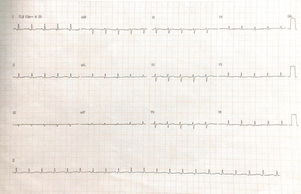 Mujer de 63 años con disnea e hipotensión debidas a taponamiento cardíaco en contexto de metástasis pericárdicas y pleurales de CA de mama