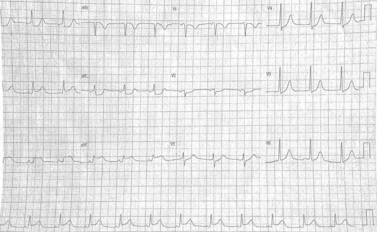 Mujer con angor prolongado e hipotensión por disección aórtica con compromiso de CD, VD con ruptura y taponamiento cardíaco