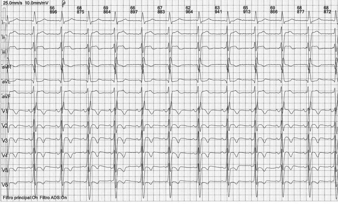 Hombre de 72 años con antecedente de ablación de aleteo auricular hace 5 años que presenta Síndrome de Bayés