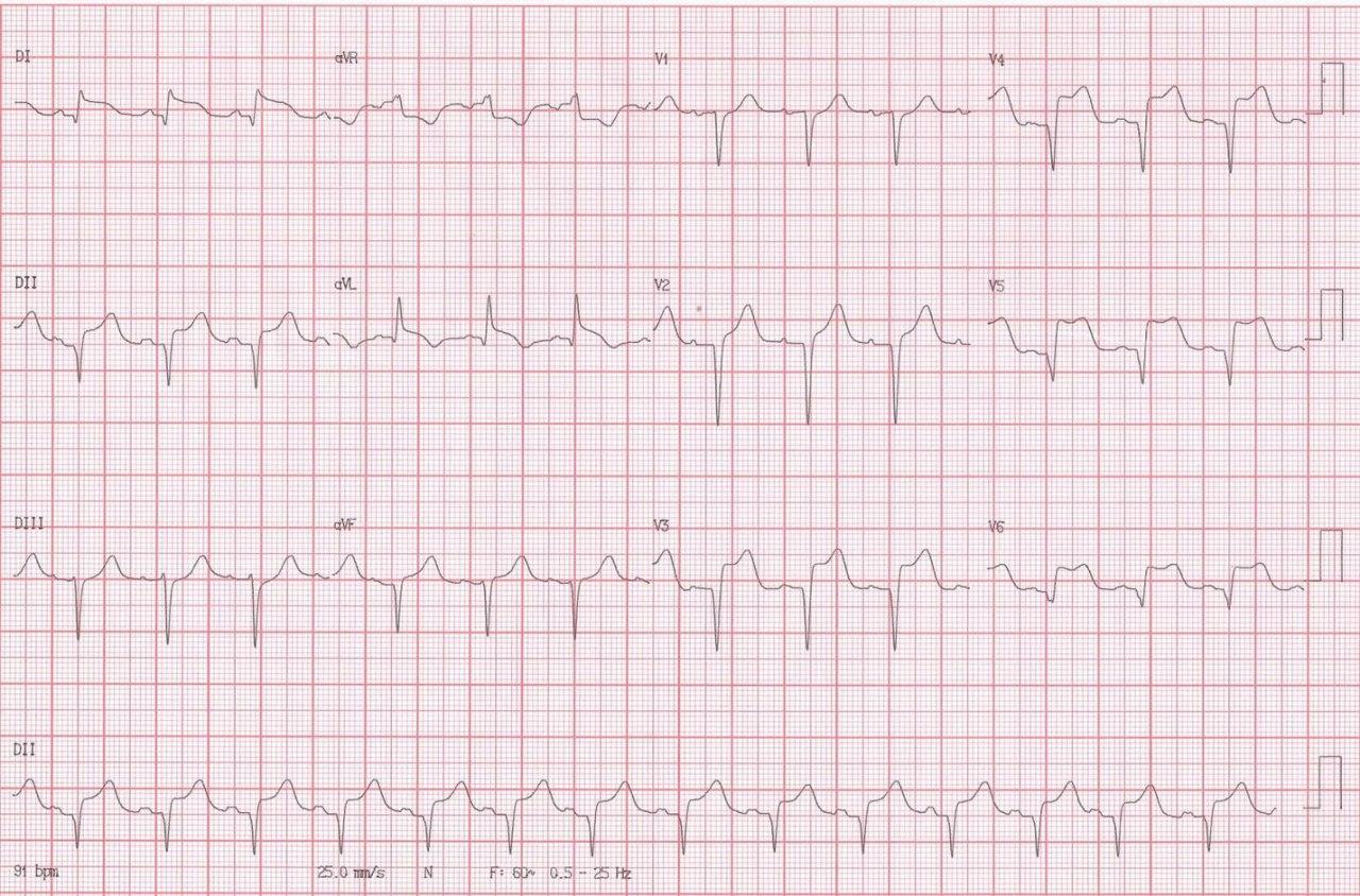 Mujer de 72 años con crisis hipertensiva, cefalea intensa y disminución del sensorio en la que se detecta síndrome de takotsubo y hemorragia subaracnoidea con inundación ventricular