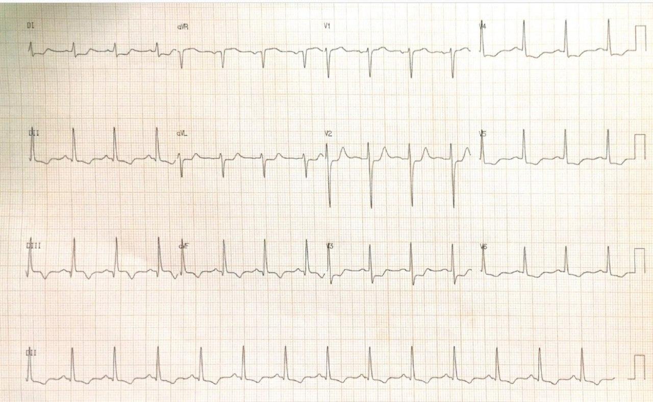 Hombre de 48 años con factores de riesgo y floridos antecedentes familiares de enfermedad coronaria que cursa con angor prolongado y desarrolla BAVC por lesión con trombo en CD, trombo en DA y severa lesión en Cx con evolución ominosa