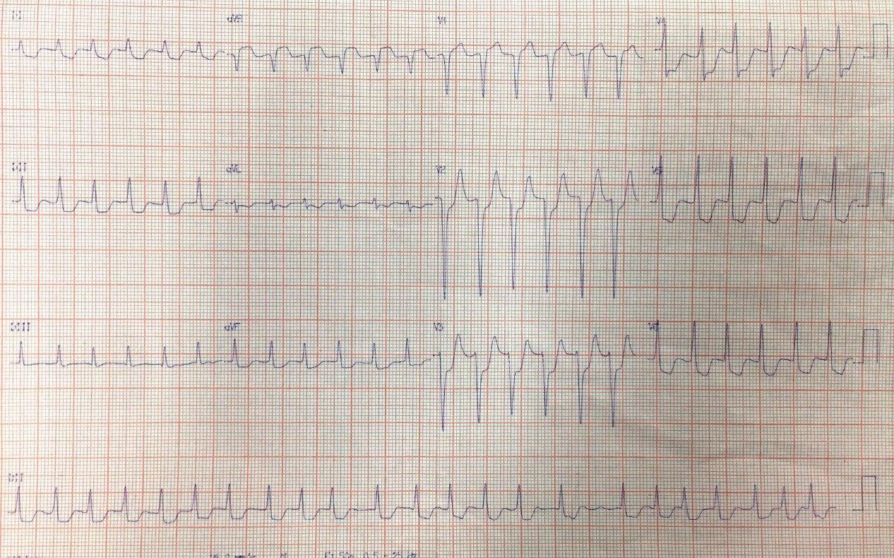 Hombre de 68 años con palpitaciones y angor que persiste al disminuir la FC de la FA por suboclusión de TCI