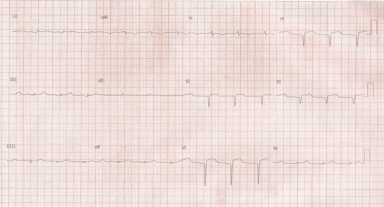 Mujer de 56 años con dolor toráccico prolongado luego se stress cuyo diagnóstico aún controversial podría ser SCACEST o síndrome de takotsubo