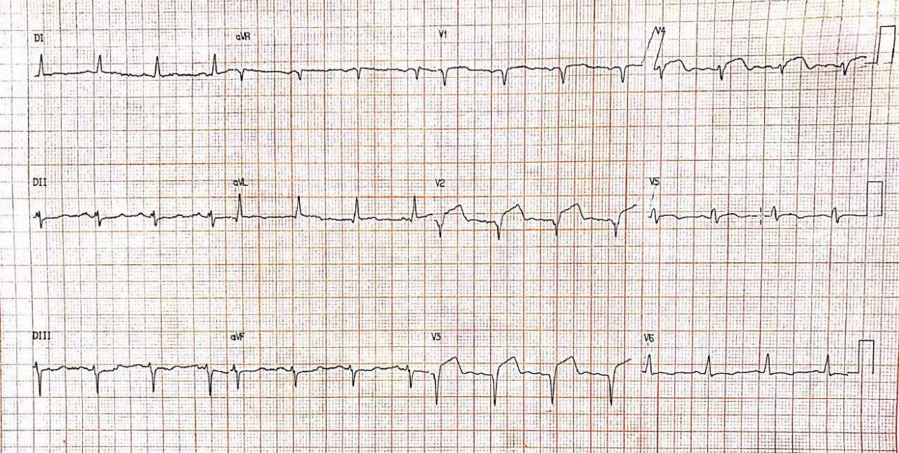 Mujer de 83 años portadora de enfermedad de Alzheimer con antecedente de implante de stent no fármaco activo en DA hace 4 años que cursa con diaforesis y vómitos por trombosis tardía del stent